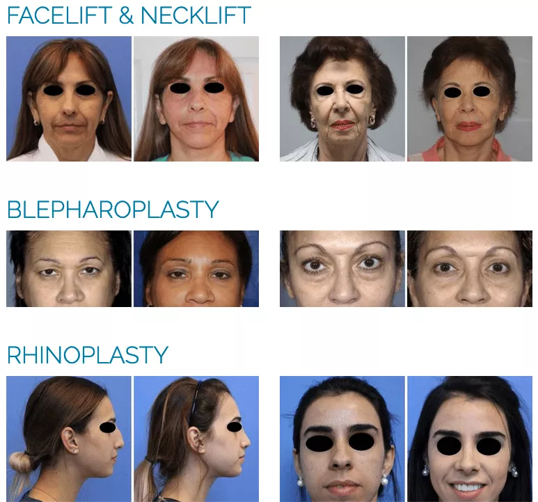 bad plastic surgery before and after photos